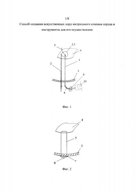 Способ создания искусственных хорд митрального клапана сердца и инструменты для его осуществления (патент 2654075)