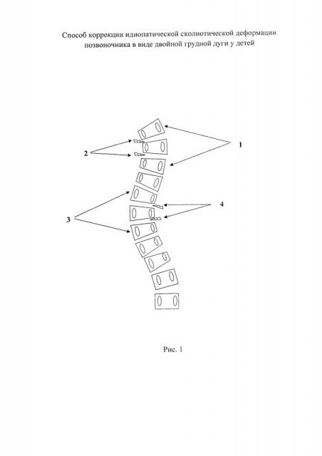 Способ коррекции идиопатической сколиотической деформации позвоночника в виде двойной грудной дуги у детей (патент 2651111)