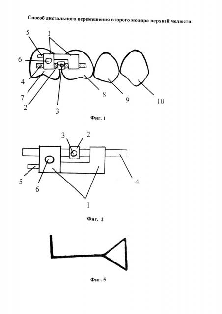 Способ дистального перемещения второго моляра верхней челюсти (патент 2656526)
