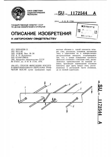 Способ фиксации косого и винтообразного перелома трубчатой кости (патент 1172544)