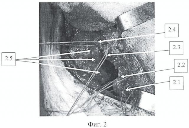 Способ эндопротезирования больных коксартрозом с сопутствующей наружной ротационной контрактурой тазобедренного сустава 2-3-й степени (патент 2432133)