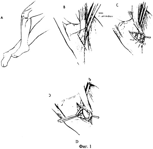 Способ аутопластики малоберцовых связок голеностопного сустава сухожилием полусухожильной мышцы бедра (патент 2257864)