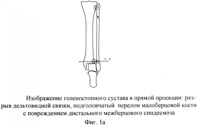 Способ оперативного лечения подголовчатых переломов малоберцовой кости при переломовывихах в голеностопном суставе (патент 2369341)