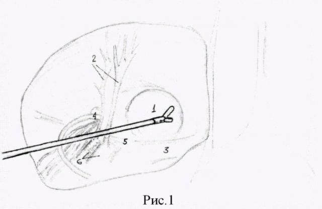 Способ укрепления пахового канала при прямой паховой грыже путем пластики поперечной фасции эндопетлей (патент 2498778)