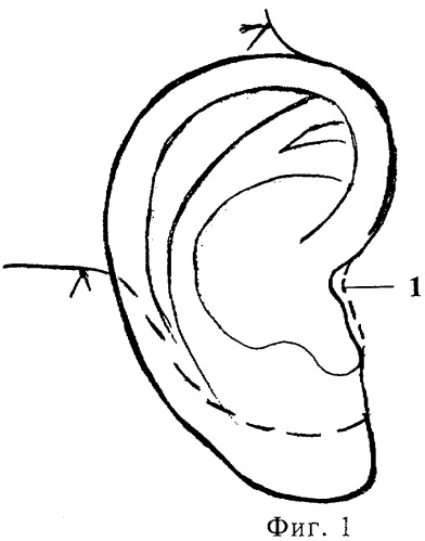 Способ формирования козелка ушной раковины (патент 2284764)