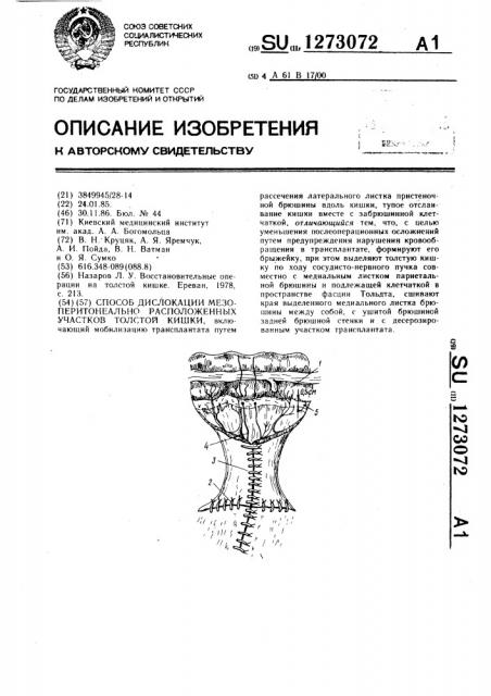 Способ дислокации мезоперитониально расположенных участков толстой кишки (патент 1273072)