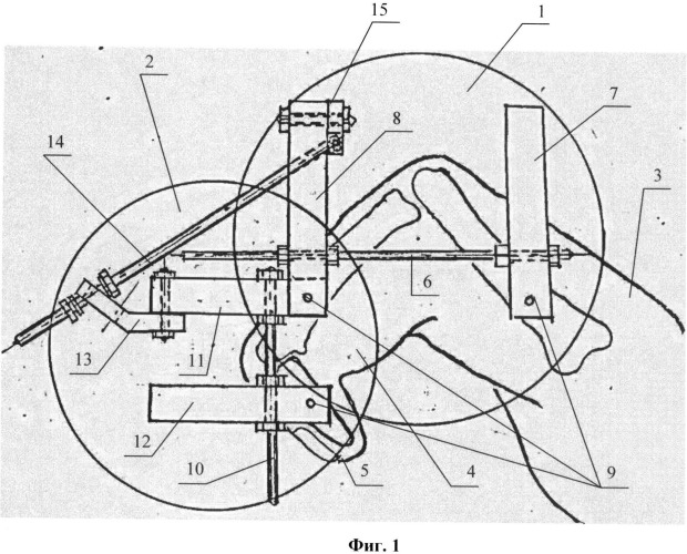 Устройство дозированной дистракции (патент 2514888)
