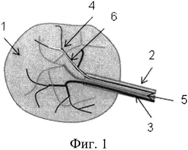 Способ моделирования артериальной аневризмы (патент 2541050)