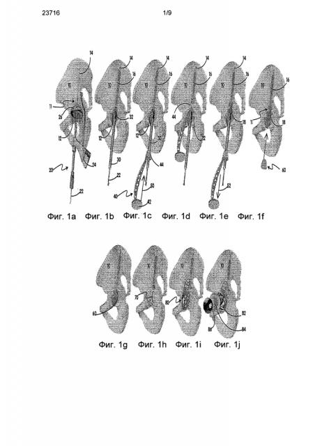Способ и устройство для артропластики вертлужной впадины (патент 2596717)