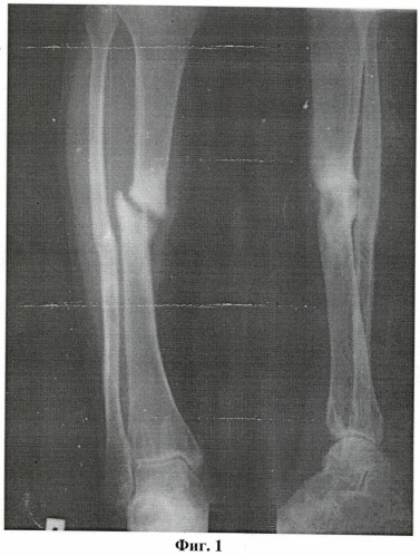Способ лечения длительносрастающихся, несросшихся переломов и ложных суставов длинных костей (патент 2406462)