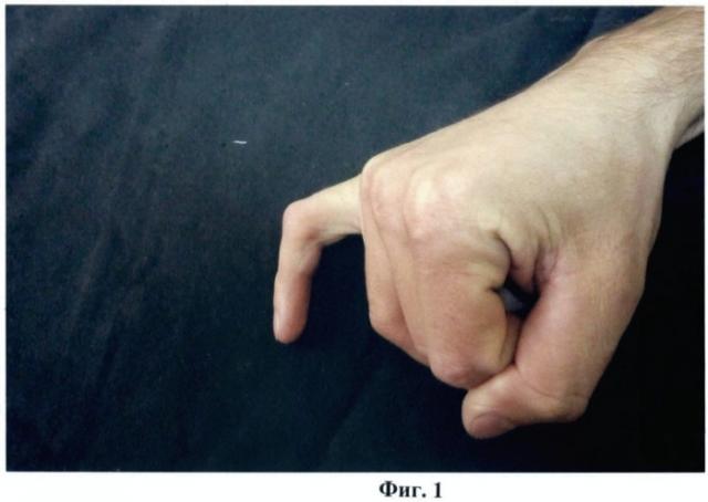 Способ устранения тендо-десмогенной сгибательной контрактуры пальца кисти (патент 2459593)