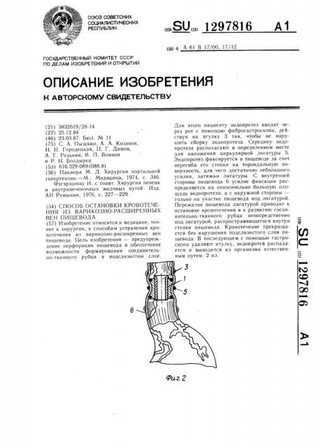 Способ остановки кровотечения из варикозно-расширенных вен пищевода (патент 1297816)