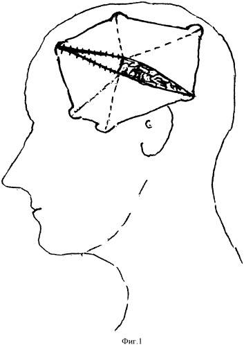 Способ вскрытия и пластики твердой мозговой оболочки (патент 2528821)