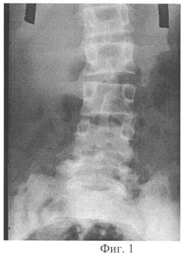 Способ соединения тел позвонков (патент 2340302)
