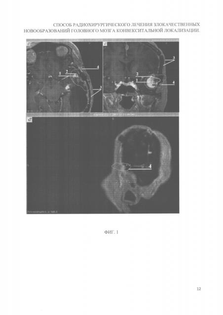 Способ радиохирургического лечения злокачественных новообразований головного мозга конвекситальной локализации (патент 2662204)