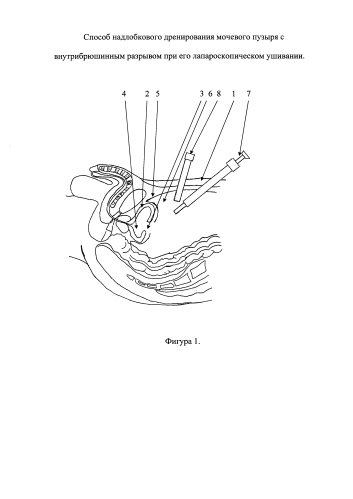Способ надлобкового дренирования мочевого пузыря с внутрибрюшинным разрывом при его лапароскопическом ушивании (патент 2592023)