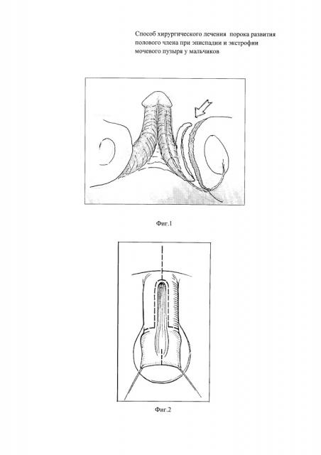 Способ хирургического лечения порока развития полового члена при эписпадии и экстрофии мочевого пузыря у мальчиков (патент 2650200)