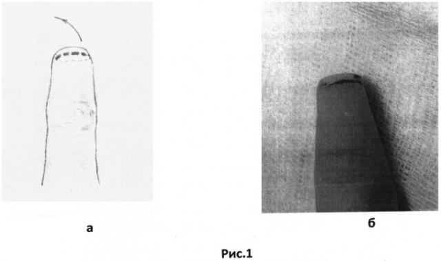 Способ восстановления ногтевого матрикса пальца кисти (патент 2494682)