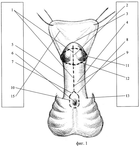 Способ хирургической коррекции проксимальных форм гипоспадии (патент 2449738)