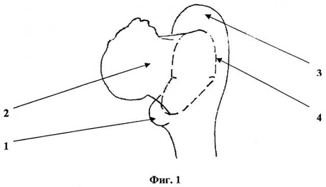 Способ профилактики интраоперационных осложнений при эндопротезировании тазобедренного сустава (патент 2290138)