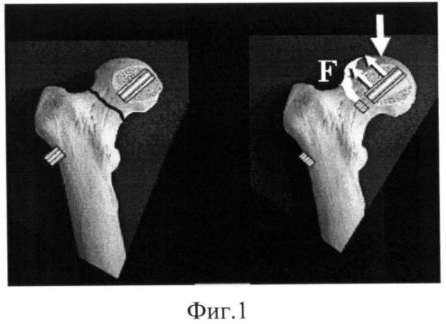 Способ остеосинтеза переломов шейки бедра и устройство для его осуществления (патент 2525739)