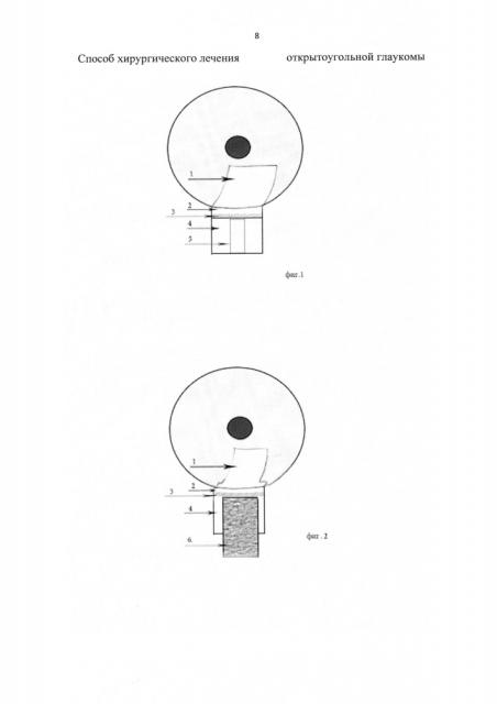 Способ хирургического лечения открытоугольной глаукомы (патент 2662904)