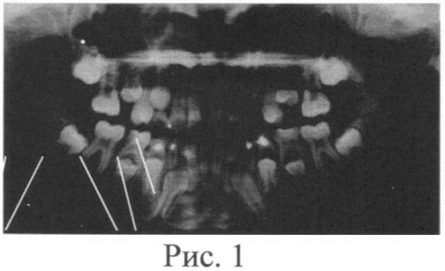Способ коррекции направления прорезывания постоянных боковых зубов (патент 2546098)