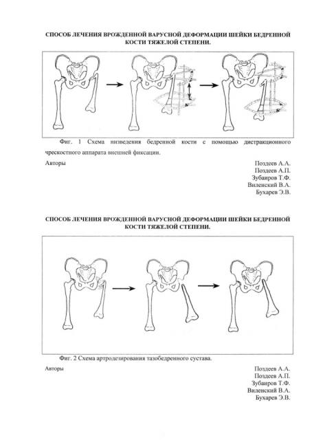 Способ лечения врожденной варусной деформации шейки бедренной кости тяжелой степени (патент 2635441)