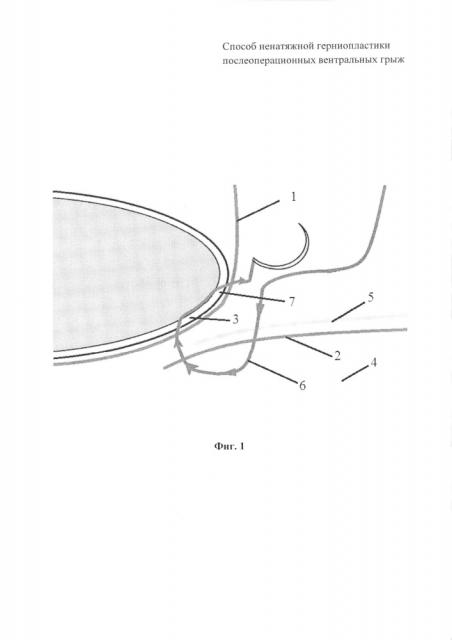 Способ ненатяжной герниопластики послеоперационных вентральных грыж (патент 2647148)