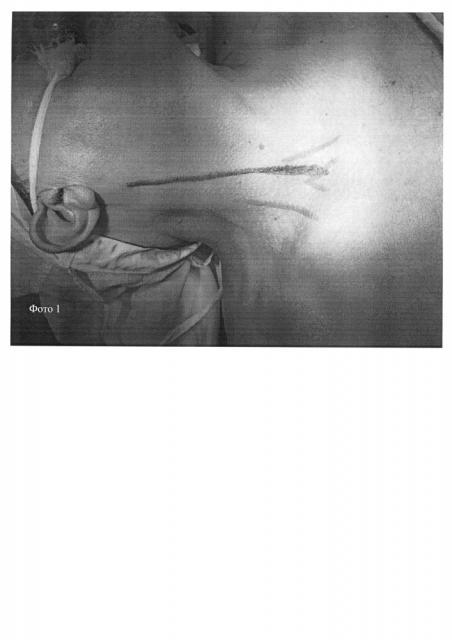 Способ хирургического доступа к сонным и подключичной артериям при одноментных вмешательствах по поводу одностороннего атеросклеротического поражения (патент 2645656)