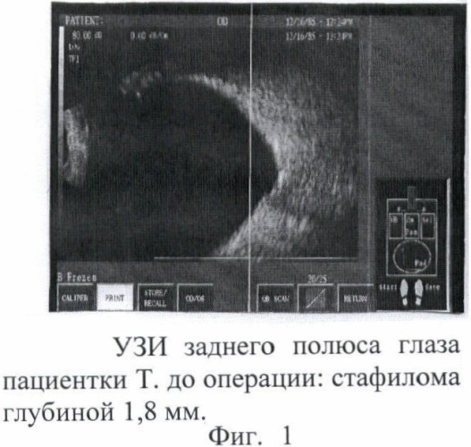 Способ склерореконструктивного лечения высокой близорукости (патент 2367394)