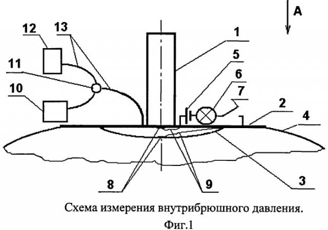 Способ измерения внутрибрюшного давления (патент 2520764)