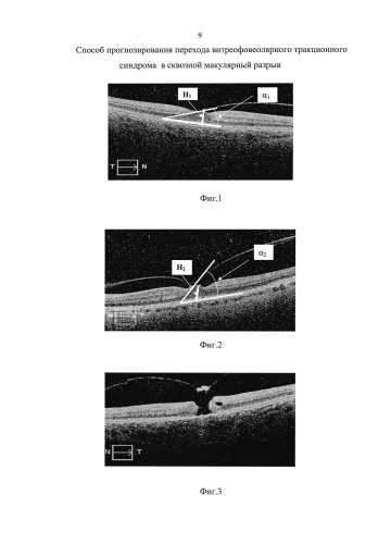 Способ прогнозирования перехода витреофовеолярного тракционного синдрома в сквозной макулярный разрыв (патент 2576813)