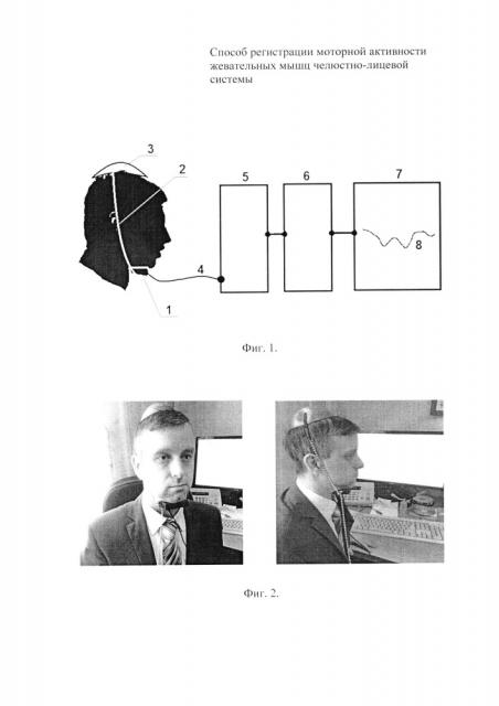 Способ регистрации моторной активности жевательных мышц челюстно-лицевой системы (патент 2652749)