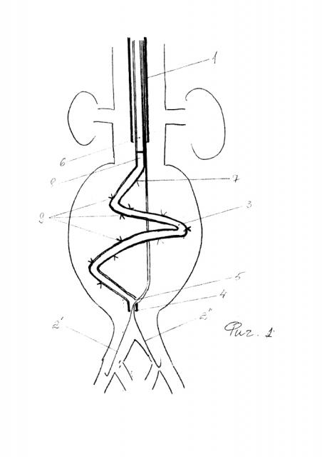 Способ лечения аневризмы кровеносного сосуда (варианты) (патент 2633629)