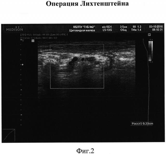 Способ прогнозирования послеоперационных осложнений после грыжесечений в отдаленный послеоперационный период (патент 2644938)