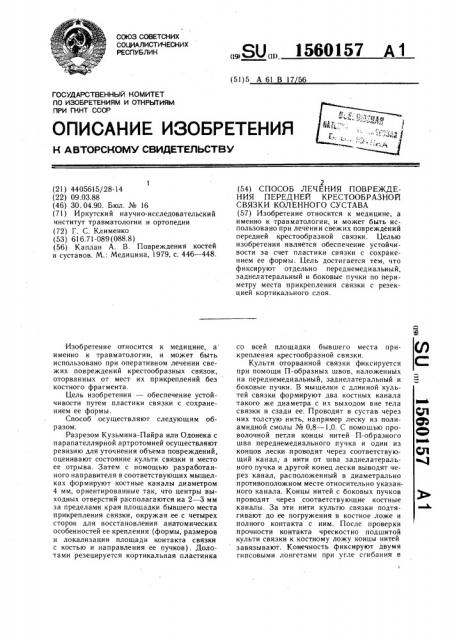 Способ лечения повреждения передней крестообразной связки коленного сустава (патент 1560157)