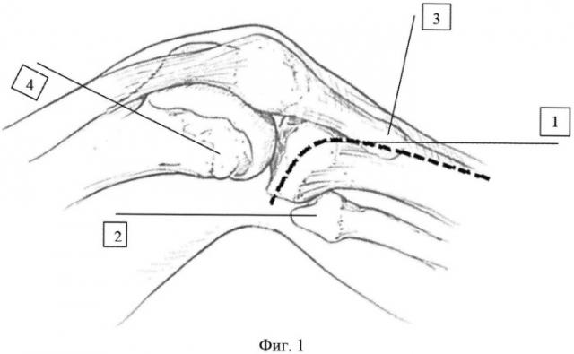 Хирургический доступ к наружному мыщелку большеберцовой кости для остеосинтеза при переломах (патент 2525211)