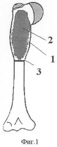 Способ лечения кистозных образований длинных трубчатых костей (патент 2307611)