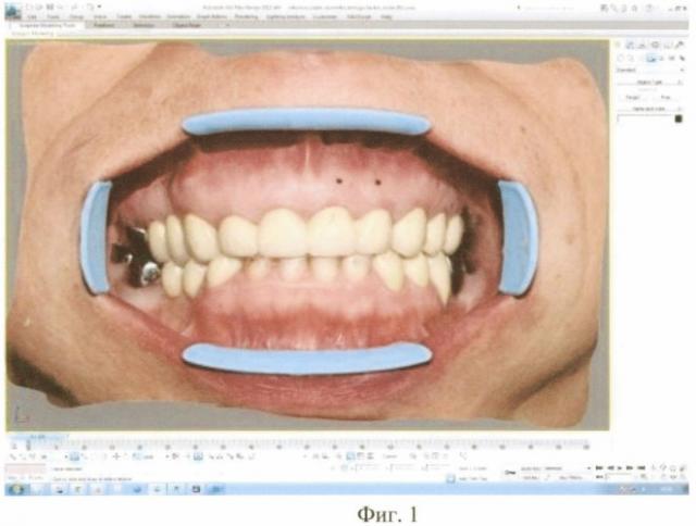 Способ создания трехмерного дизайн-проекта краевого пародонта (патент 2508068)