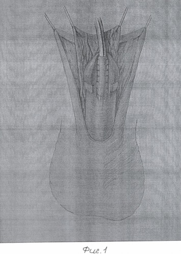 Способ хирургического лечения гипоспадии у мальчиков (патент 2371104)