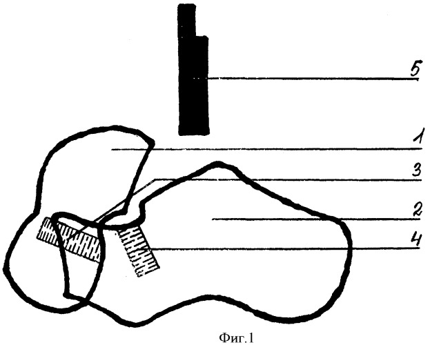 Способ лечения плоско-вальгусной деформации стопы у детей (патент 2372041)