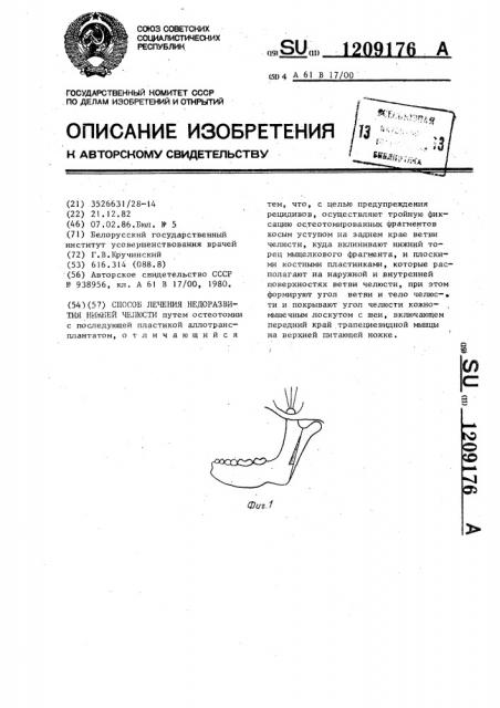 Способ лечения недоразвития нижней челюсти (патент 1209176)