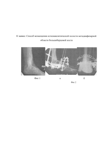 Способ возмещения остеомиелитической полости метадиафизарной области большеберцовой кости (патент 2582051)