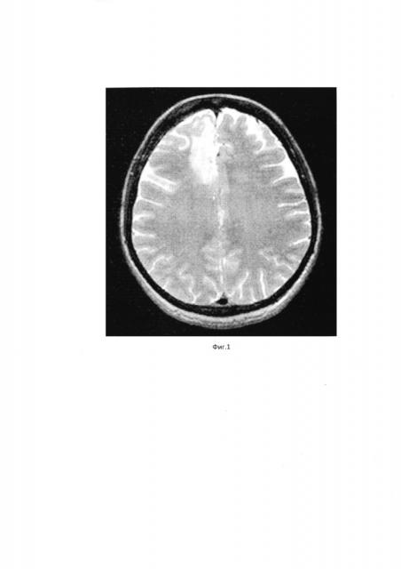 Способ хирургического лечения опухолей головного мозга (патент 2657380)