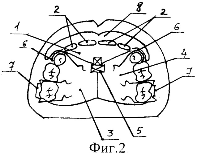Устройство для формирования физиологических соотношений зубоальвеолярных дуг при раннем удалении временных резцов (патент 2254095)