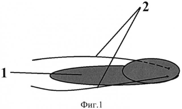 Способ и устройство для реконструкции нижней стенки орбиты и устранения энофтальма (патент 2530752)