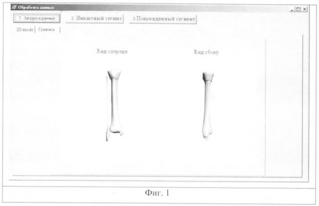Способ трехмерной визуализации длинных трубчатых костей при диафизарных переломах (патент 2342077)
