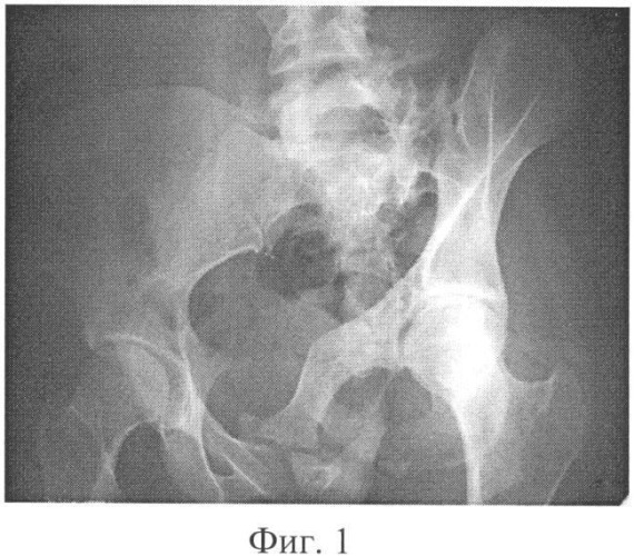 Способ реконструкции таза при стабильном, неправильно сросшемся переломе (патент 2349277)