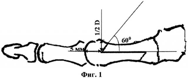 Способ лечения деформации первого пальца стопы (патент 2423084)